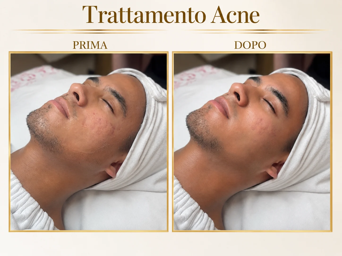 Prima e dopo: Trattamento acne