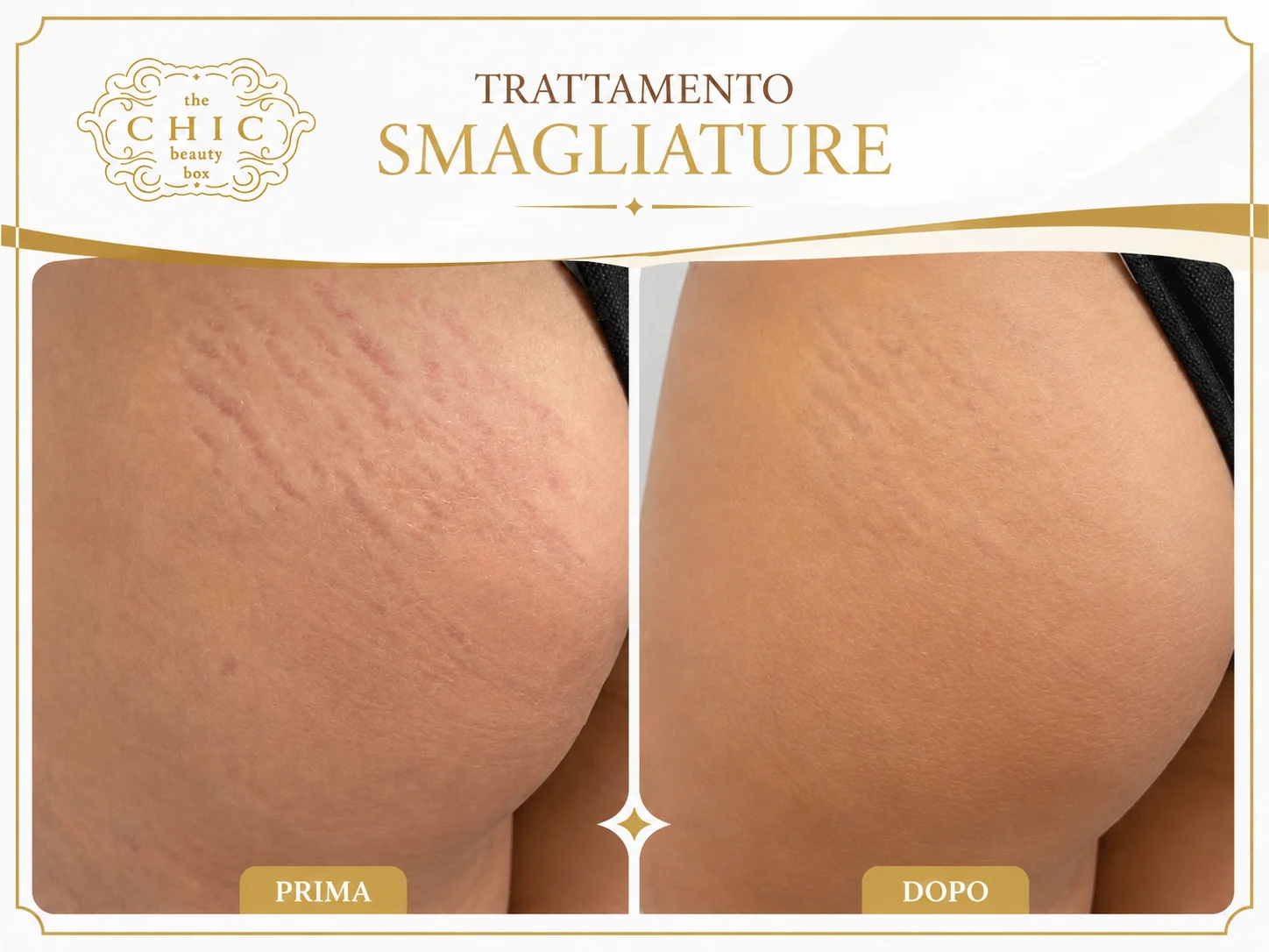 Prima e dopo: Smagliature