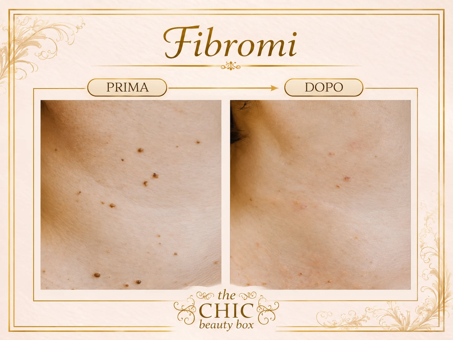 Prima e dopo: Fibromi