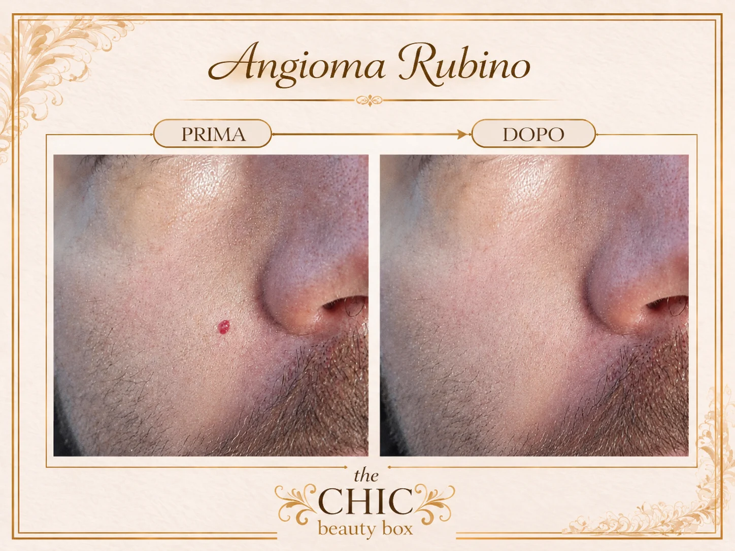 Prima e dopo: Angioma rubino