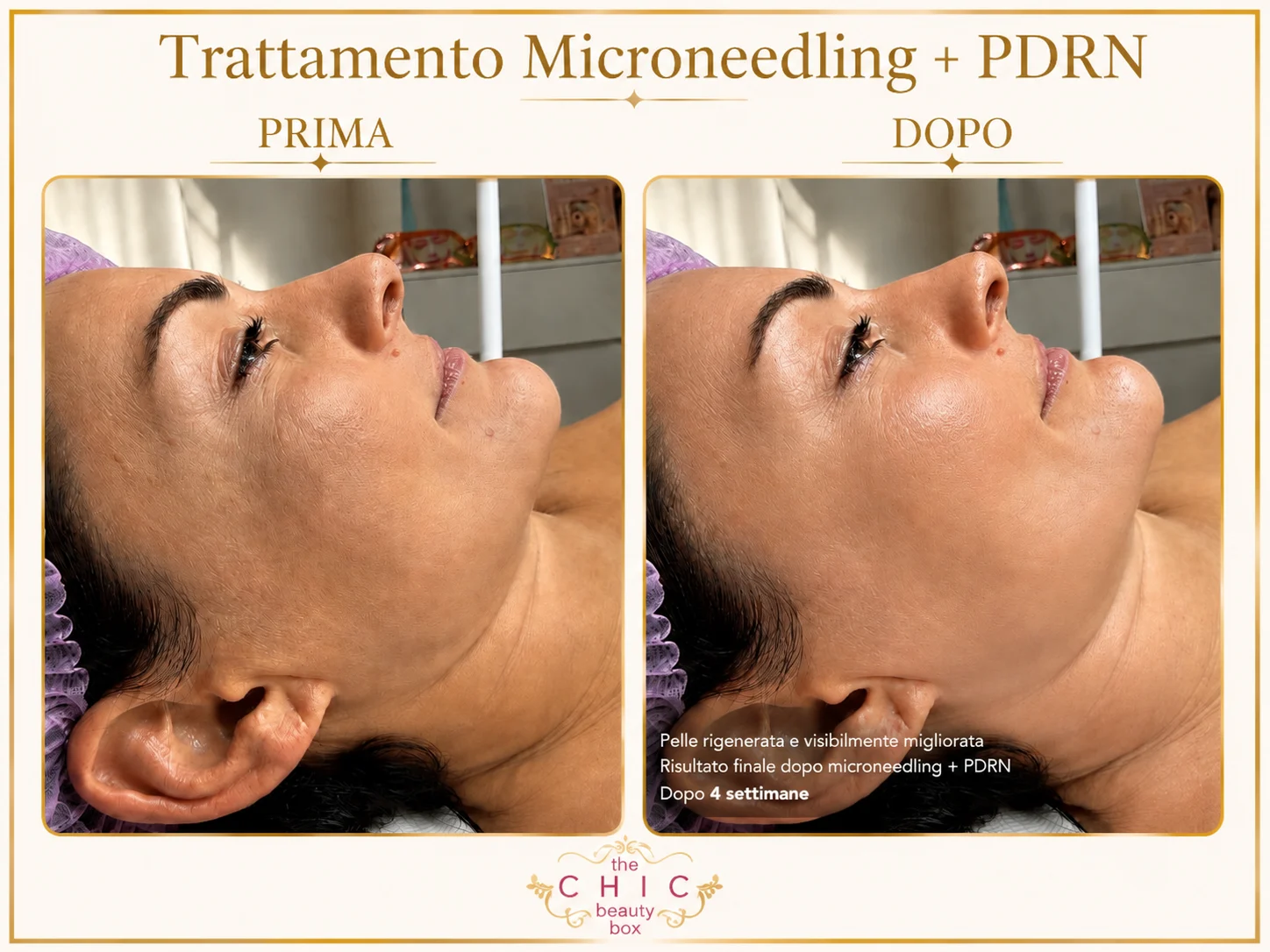 Prima e dopo: Microneedling · PDRN