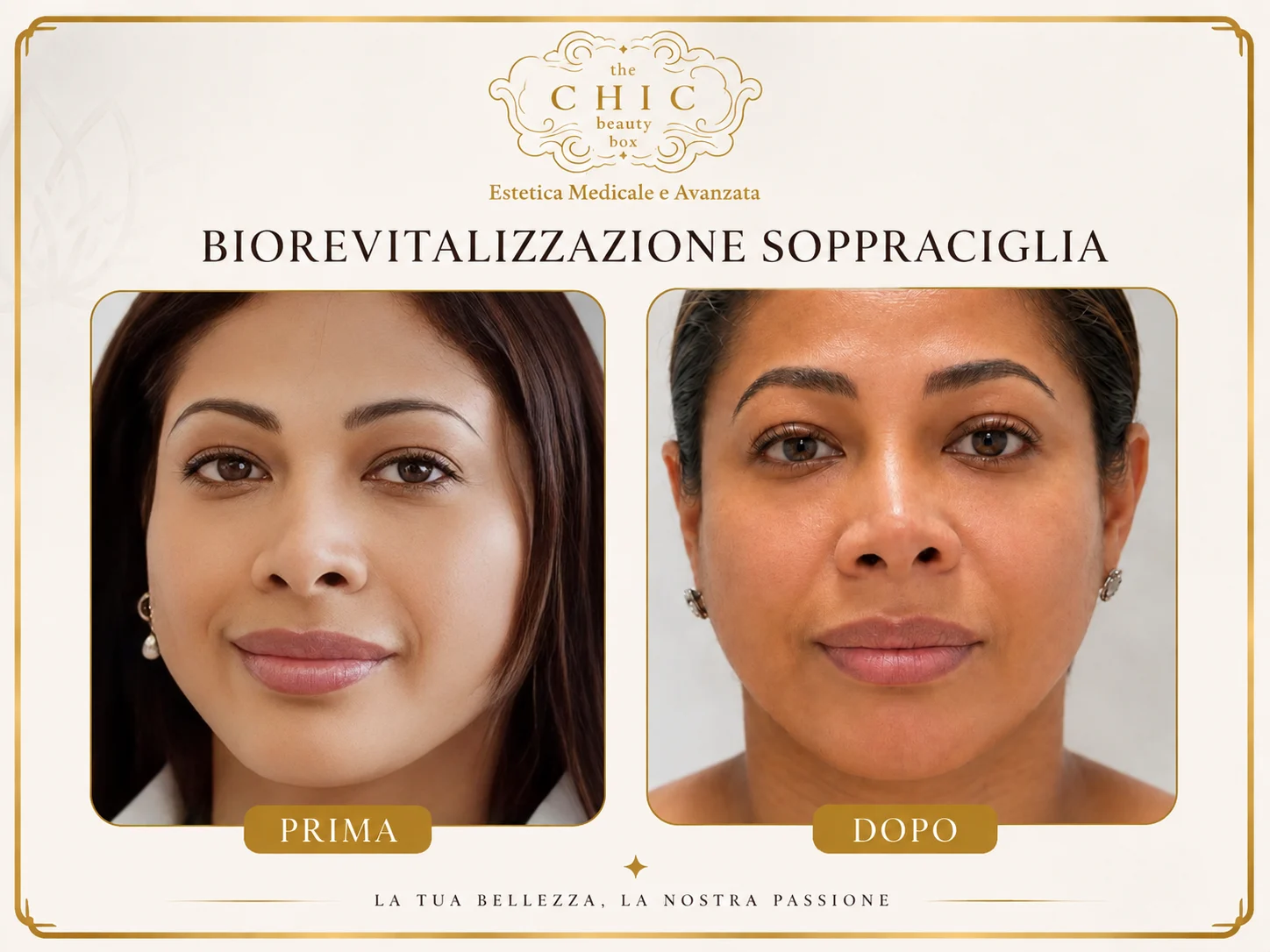 Prima e dopo: Biorivitalizzazione sopracciglia