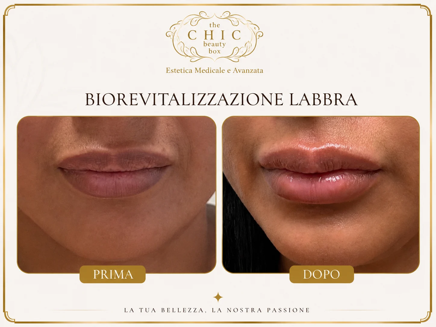 Prima e dopo: Biorivitalizzazione labbra